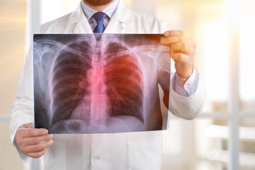 Medical professional examining a chest X-ray for signs of Legionnaires' disease, illustrating the importance of early detection and treatment in combating this respiratory infection.